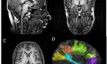 התקן ה-FIBER MRI של חברת ביואימג' המשמש למעקב אחר גידולים סרטניים