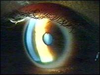 עוורים יוכלו לזהות פנים באמצעות העין הביונית