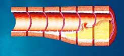 A blocked artery in a patient with atherosclerosis