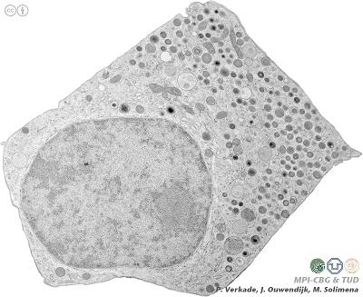 A β-cell under a penetrating electron microscope. The nucleus in the lower-left corner. The insulin granules in the upper-right corner. (Source: Wikipedia)