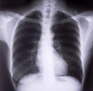 צילום ריאות של חולה במחלת COPD. צילום באדיבות חברת גלקסו סמית קליין
