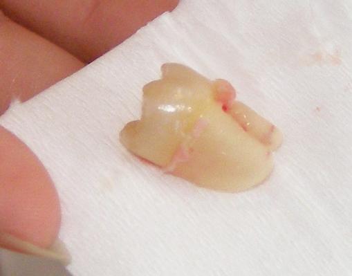 A displaced wisdom tooth, from Wikipedia. Is this a new source of stem cells?