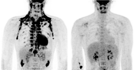 Exposure of an adult to cold temperature (left) and room temperature, and a CT scan taken of him shows the dark signature of the brown fat. From the article by Van Merken, Lichtenblatt and associates, New England Journal of Medicine, 2009