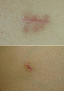 In the upper picture: a cut near the navel which is closed with sewing thread and a needle. In the bottom picture, another incision was made in the abdomen of the same patient, which was fused using a laser welding system. Photo: Prof. Avraham Katzir