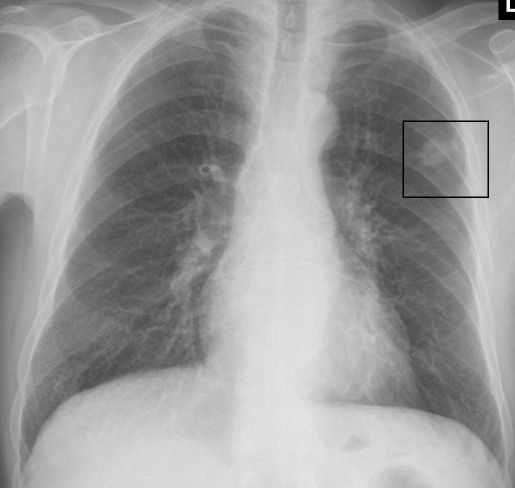 X-ray image of a tumor in the chest.