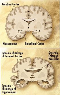 تورم الدماغ عند مرضى الزهايمر. بإذن من ألون ثيرابيتكس