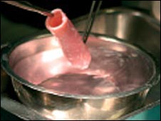 The transplanted trachea