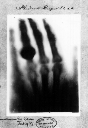 כף ידה של אנה ברטה רנטגן - צילום הרנטגן הראשון, 22 בדצמבר 1895