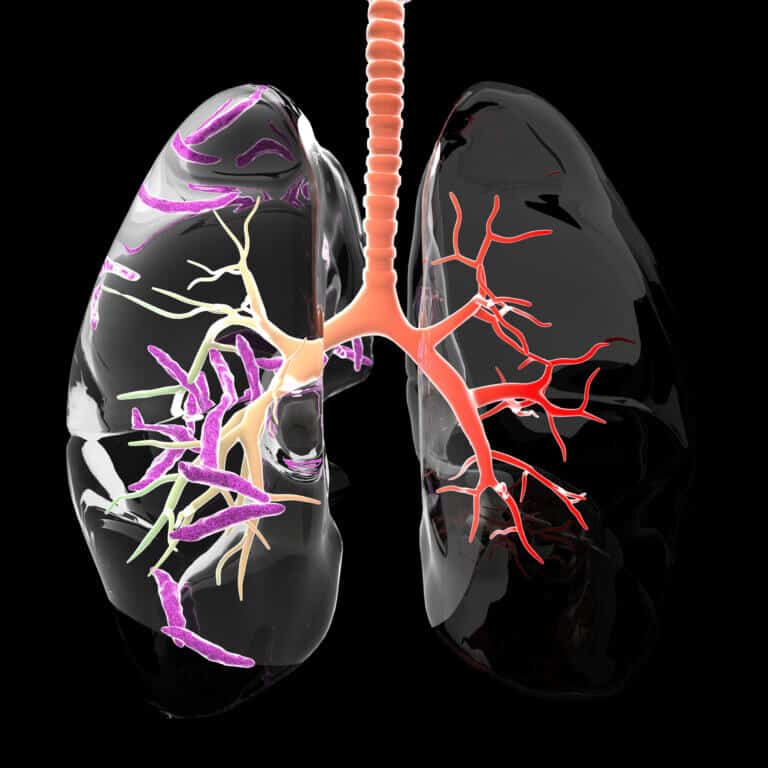 Comparison between the lungs of a tuberculosis patient versus a healthy person. Image: depositphotos.com