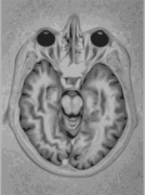 תמונת MRI של מח אנושי. מתוך ויקיפדיה