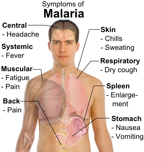 סימפטומים של מלריה