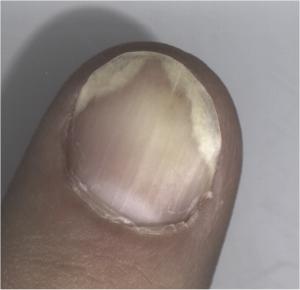 Psoriasis of the nail