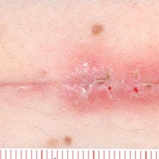 Section of skin excision two weeks after surgery. Deep sutures were performed to bring the sides of the incision closer together and then it was closed in the upper layer using two different methods: on the right side - by means of stitches and on the left side using the technology described in the article. The difference is noticeable. The redness on the right side is caused by the stitches and leads to scarring.