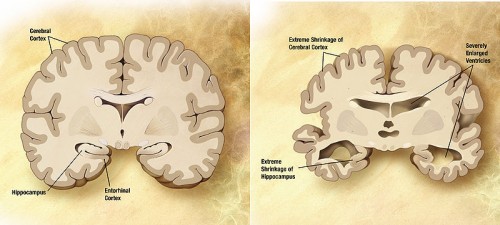 دماغ طبيعي (يسار) ودماغ مصاب بمرض الزهايمر (يمين). من ويكيبيديا