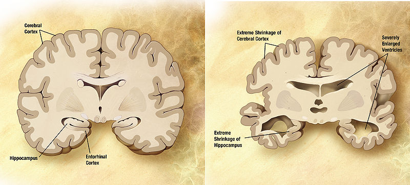 מוח רגיל (משמאל) ומוח חולה אלצהיימר (מימין)