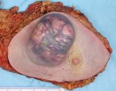 גידול בסרטן השד. צילום: מתוך ויקיפדיה