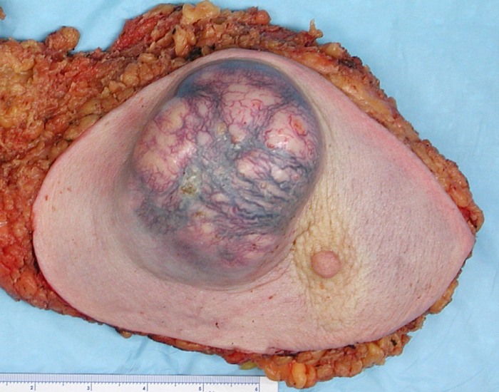 Breast cancer tumor. Photo: from Wikipedia