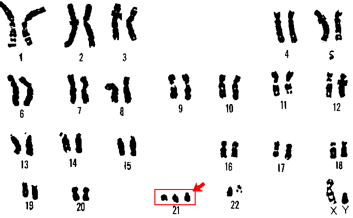 Trisomy 21 (chromosome number 21 appears 3 times) which characterizes Down syndrome