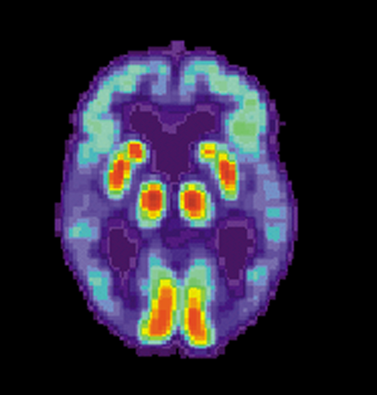 סריקת מוחו של חולה אלצהיימר. ירידה בתפקוד איזורים רבים במוח. צילום: מתוך ויקיפדיה