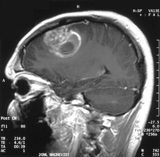 צילום NMR של מוחו של נער בן 15 הסובל מסרטן המוח גליובלסטומה. מתוך ויקיפדיה