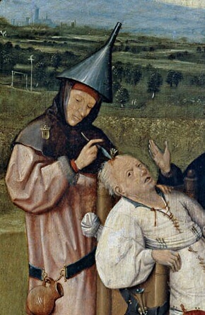 هيرونيموس بوش. عملية جراحية لإزالة الحجارة من الرأس. رسم يمثل مثالاً لجراحة الدماغ من عام 1485. من ويكيميديا