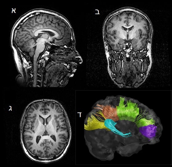 איור 1 תמונת MRI בקונטרסט T1: א - במבט חיצי (sagital), ב - במבט חזיתי (coronal), ג - במבט אופקי (axial), ד - שחזור בתלת מימד של ה-corpus callosum, מערכת סיבים של חומר לבן.