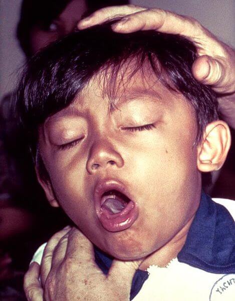 ילד חולה שעלת בעת התקף. מתוך ויקיפדיה