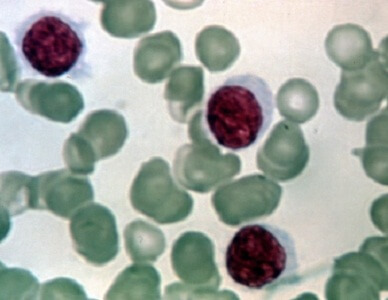 תאי סרטן הדם. באדיבות מכון ויצמן