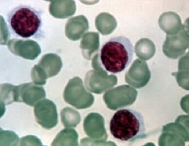 Blood cancer cells. Courtesy of the Weizmann Institute