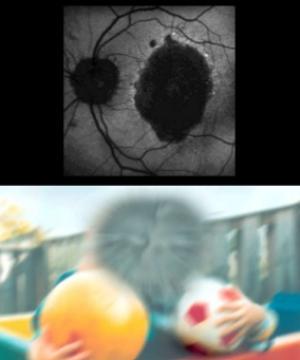 למעלה. רשתית של עינו של חולה ניוון מאקולרי (AMD). למטה:ההשפעה של AMD על מערכת הראיה המרכזית. איור: סטיבן טסאנג והמכון הלאומי לעיניים.