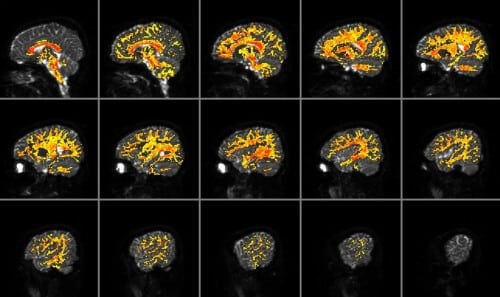 Atlas of mean nerve fiber thickness (contributed by CONNECT researchers Danny Alexander, Jeff Parker, and Denise LaBiehan).