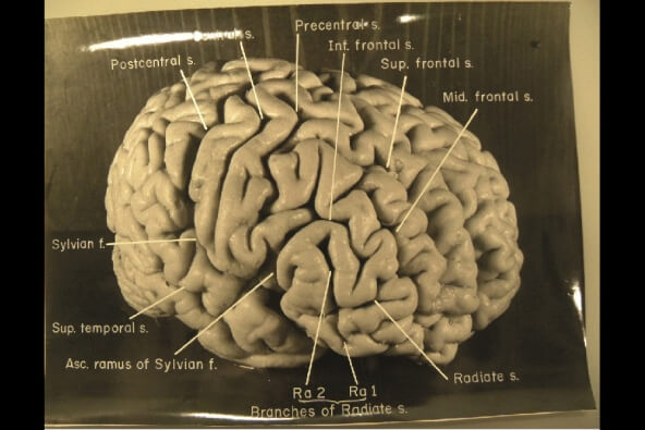 החצי הימני של מוחו של איינשטיין. צילום: National Museum of Health and Medicine