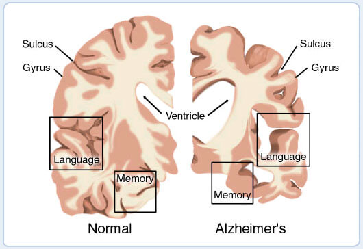 הגבול שבין חלקי המוח אצל אדם בריא ואצל חולה אלצהיימר. איור: NIH