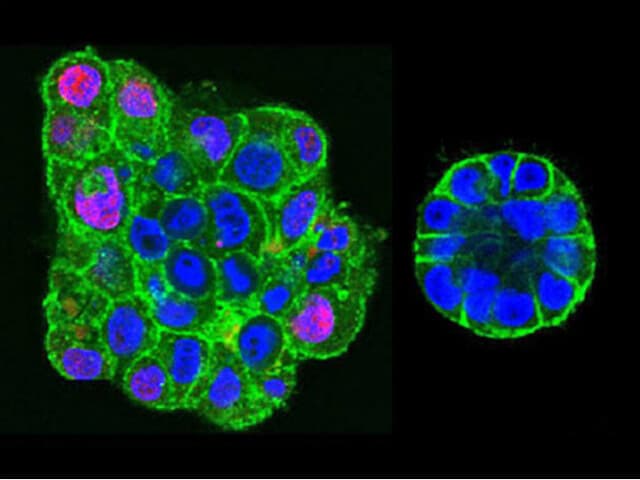 The pressure works. Breast cancer tumor cells (left), compared to the organized structure after physical stress (right). Photo: Prof. Daniel Fletcher's lab, University of Berkeley