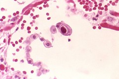 תמונת מיקרוסקופ של תאים שנדבקו ב- CMV. שימו לב לגרעין המוגדל של התא האמצעי, שמעיד על ההידבקות. המקור: ויקיפדיה.