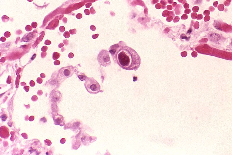 صورة مجهرية للخلايا المصابة بفيروس CMV. لاحظ تضخم نواة الخلية الوسطى مما يدل على الالتصاق. المصدر: ويكيبيديا.