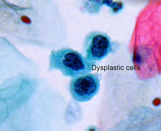 Skin cells of a patient with ectodermal dysplasia. From Wikipedia