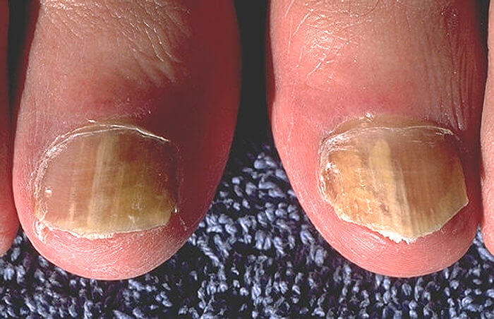 Onychomycosis caused by Trichophyton rubrum. From Wikipedia