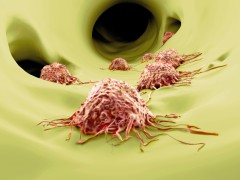 תאי סרטן נודדים בגוף. צילום: shutterstock