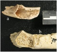 עצמות ניאנדרטל שחי לפני 120 אלף שנה באיזור שהיום הוא קרואטיה, ועליהן גידול סרטני. צילום: Janet Monge et al