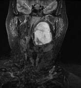 צילום MRI של ש', בו ניתן לראות את הגידול בראשה (החלק הלבן מצד ימין). צילום: דוברות בית החולים רמב"ם