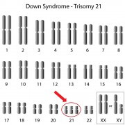 שלושה כרומוזומי 21 במקום שניים אצל חולי תסמונת דאון. איור: shutterstock