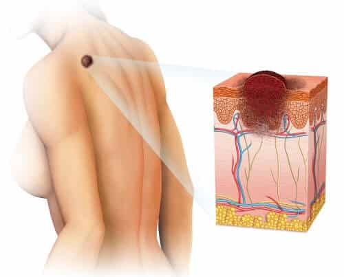 General structure of the skin layer together with melanocyte cells and a melanoma type cancer tumor. Photo: shutterstock.