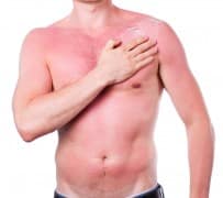 כוויות שמש. איור: shutterstock