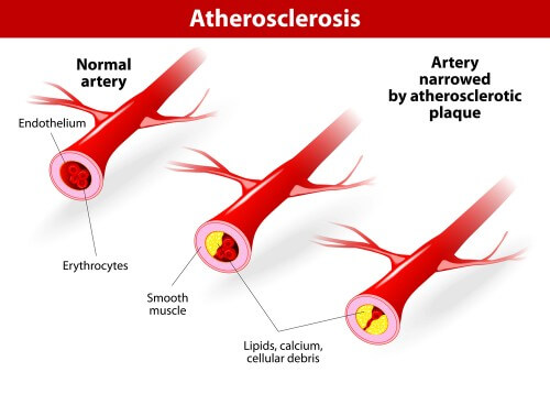 Narrowing of arteries due to excess cholesterol. Illustration: shutterstock