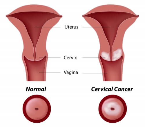 عنق الرحم الطبيعي (يسار) والسرطاني (يمين). الرسم التوضيحي: شترستوك