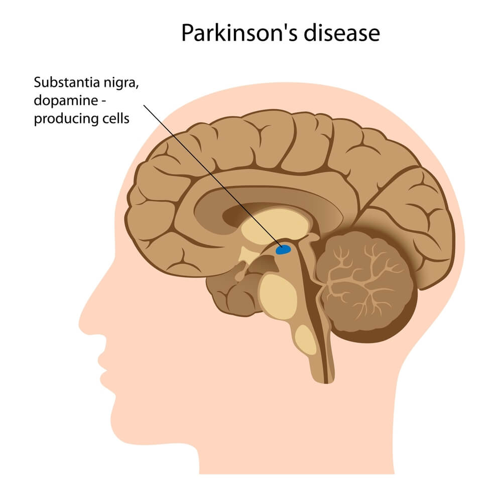 Parkinson's disease. Illustration: shutterstock