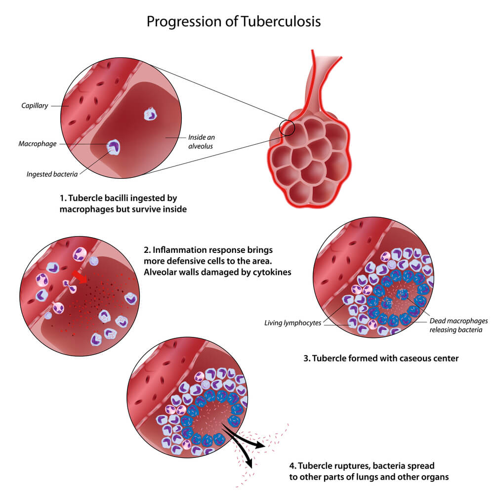 The development of tuberculosis. Illustration: shutterstock