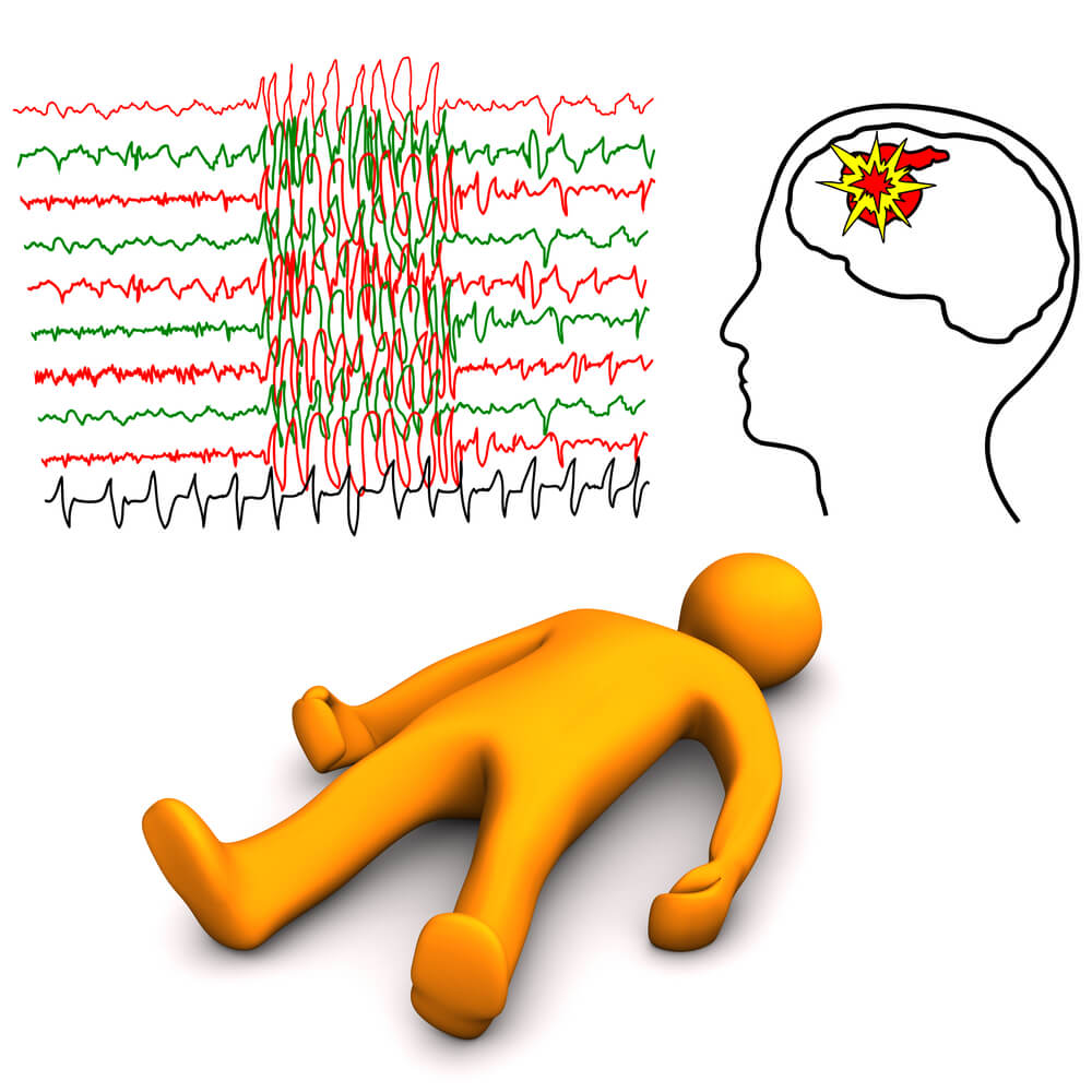 An attack of the falling disease - epilepsy. Illustration: shutterstock