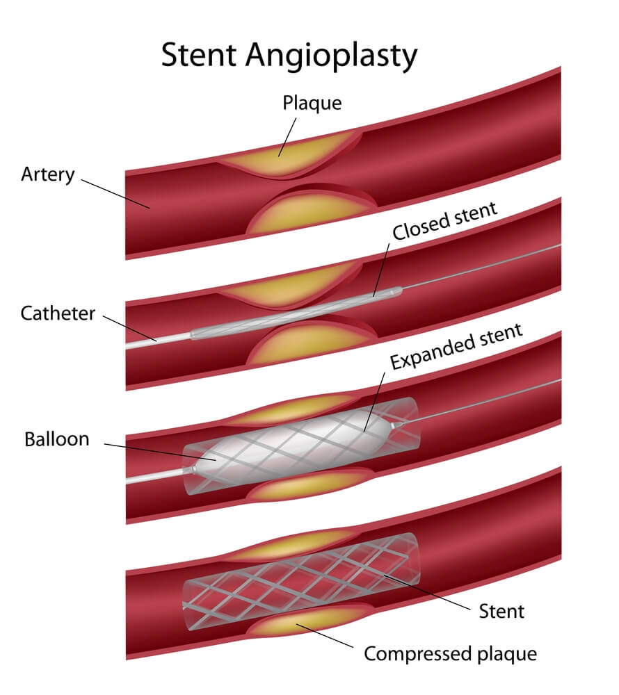 This is how a stent works. Illustration: shutterstock